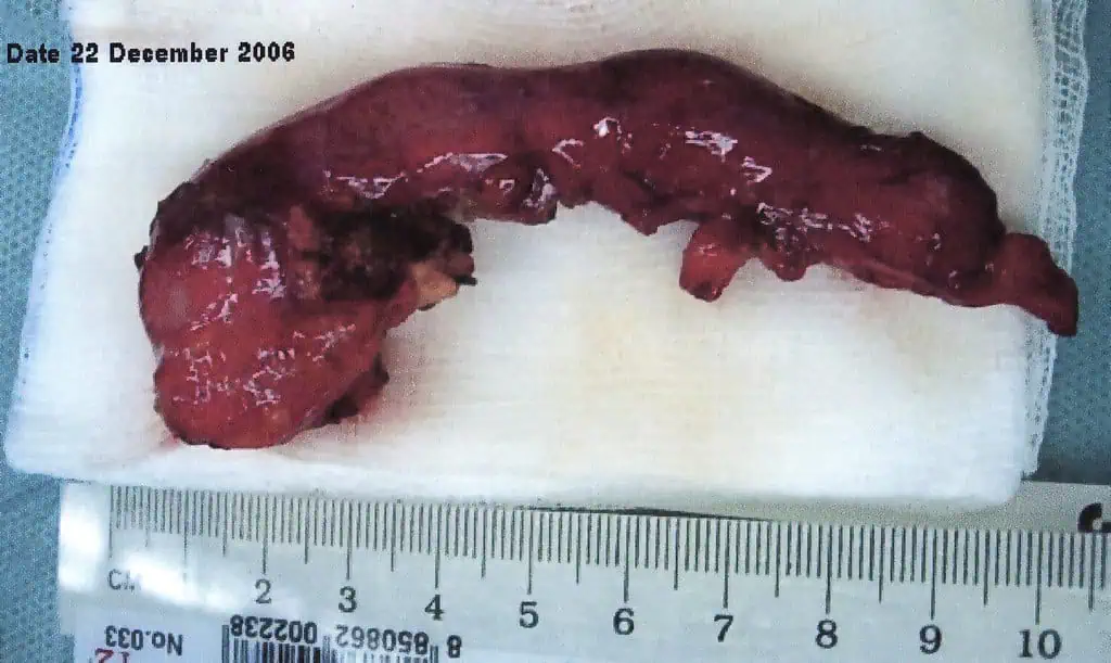 Appendectomy