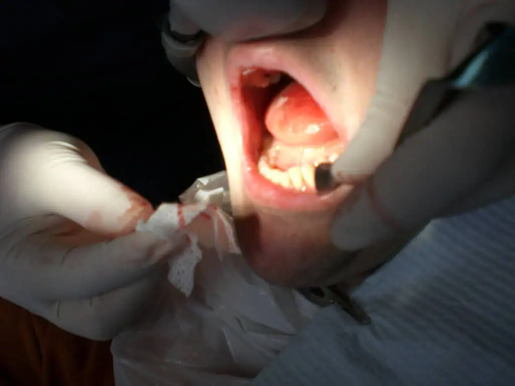 Gum Surgery