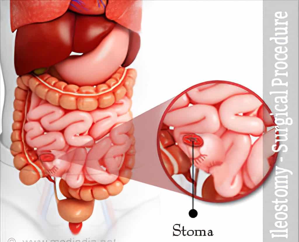 Ileostomy